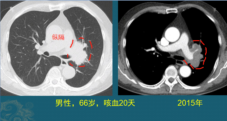 生存期较长的癌症有哪些？