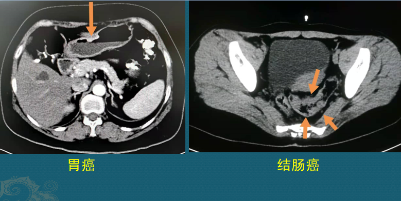 生存期较长的癌症有哪些？