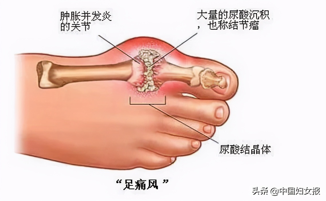 快收好！各年龄段血压、血糖、血脂、尿酸对照表全在这→