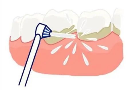 超声洗牙对牙齿有伤害吗？