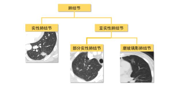 超一半人群都有的肺结节，到底会不会癌变？专家解析→