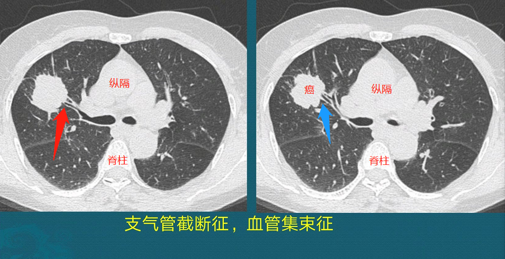 生存期较长的癌症有哪些？